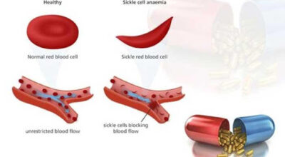 sicklecell-anaemia-kanchanpur-tato-khabar-health-tips-nepal-healthy-life-style