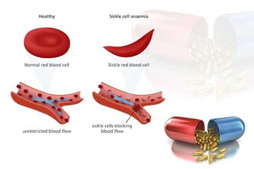 sicklecell-anaemia-kanchanpur-tato-khabar-health-tips-nepal-healthy-life-style